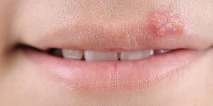 La manifestazione del virus dell'herpes sul labbro