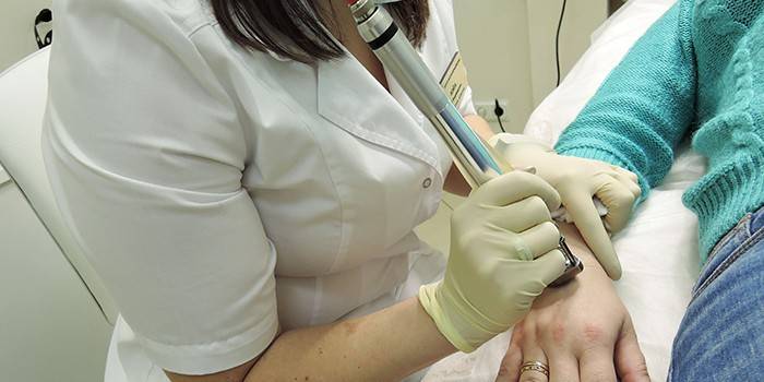 Il medico rimuove la verruca con un laser