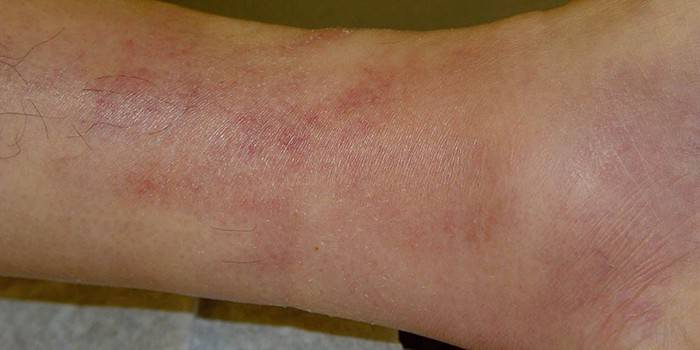 Thrombophlebitis บนขาของมนุษย์
