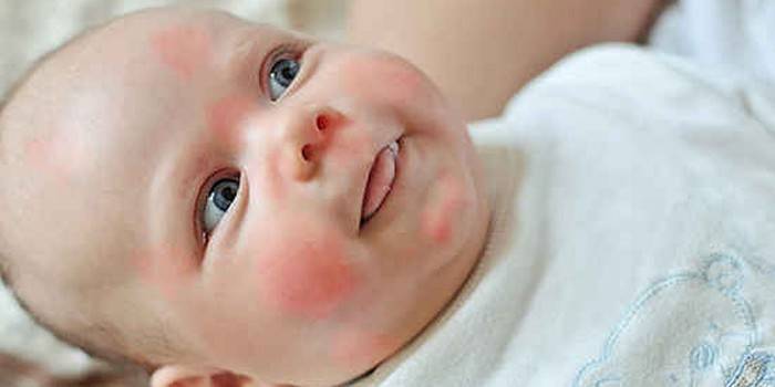 Rødhed på babyens ansigt