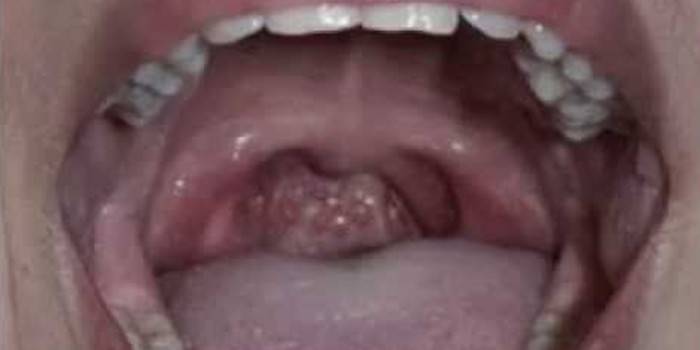 Garganta humana com dor de garganta herpética