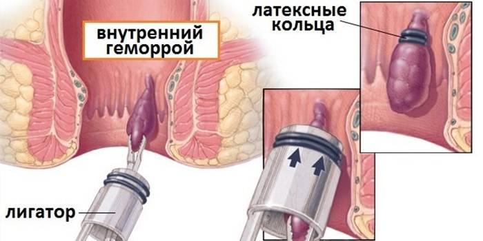 Ligationsschema Hämorrhoiden Latexringe