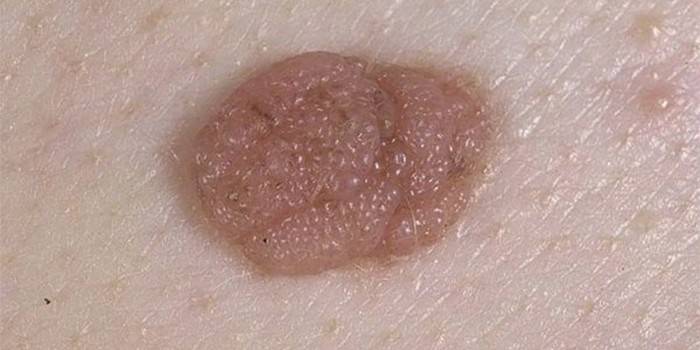 Nevus sắc tố papillomatous trên da người