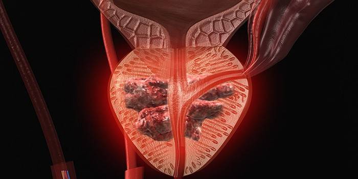 Prostata interessata