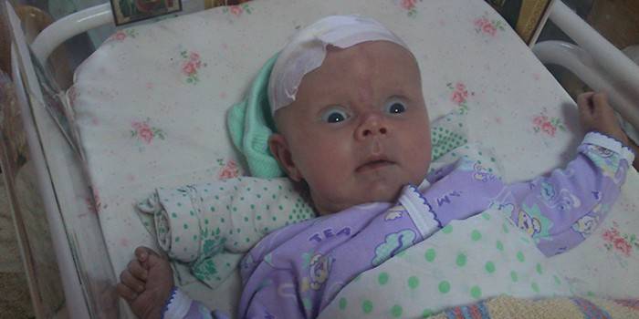 Idrocefalo infantile