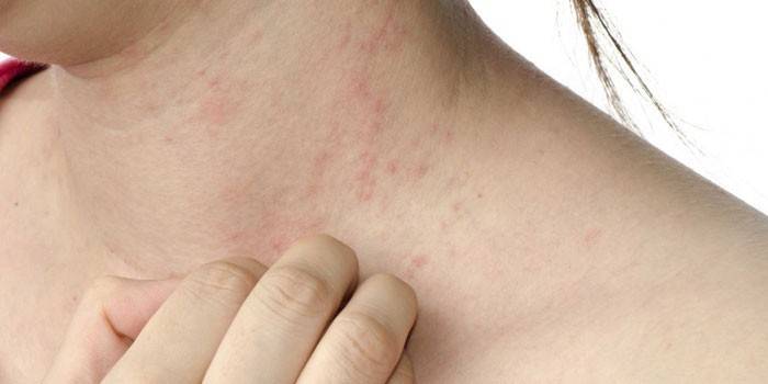 Una donna ha un'eruzione cutanea e prurito al collo