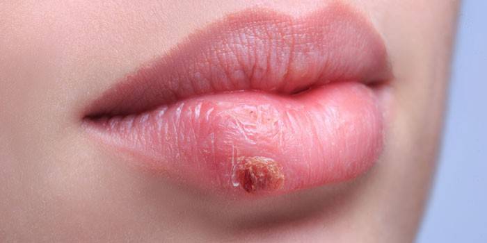 Herpes ở môi dưới của cô gái