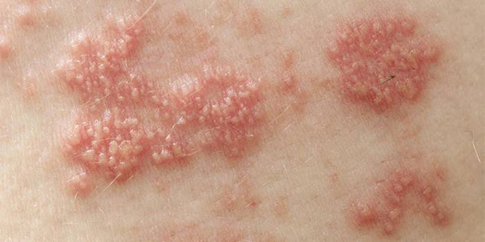 Tinea iholla