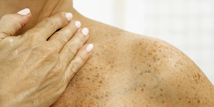 Chloasma στο σώμα μιας γυναίκας
