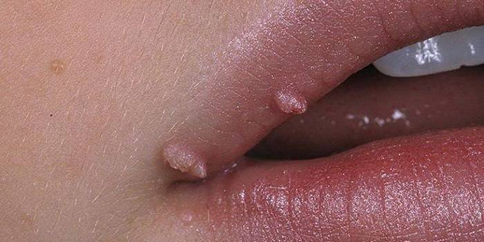 Verruche genitali sul labbro superiore di una ragazza