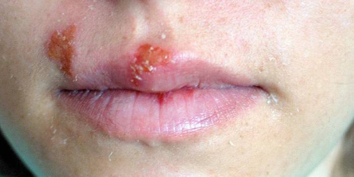 Herpes auf der Oberlippe des Mädchens