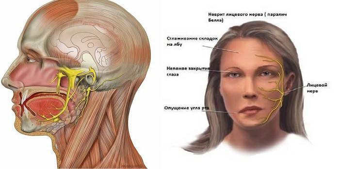 รูปแบบและโรคของเส้นประสาทใบหน้า