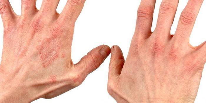 Dermatīts