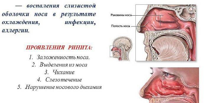 Esquema de inflamación de la mucosa.