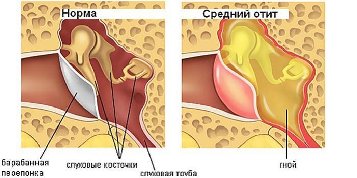 Inflamația urechii