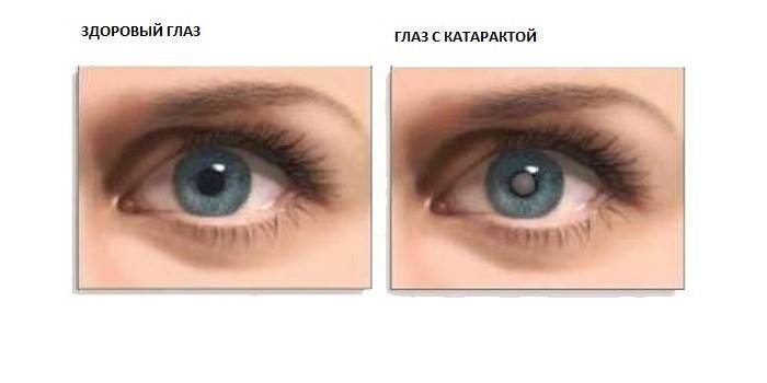 Katarakt neye benziyor?