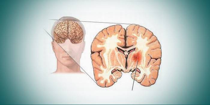 Serebral arteriyoskleroz