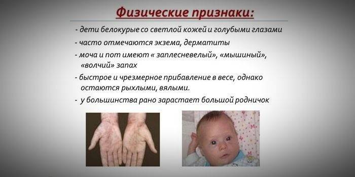 العلامات والمظاهر عند الأطفال