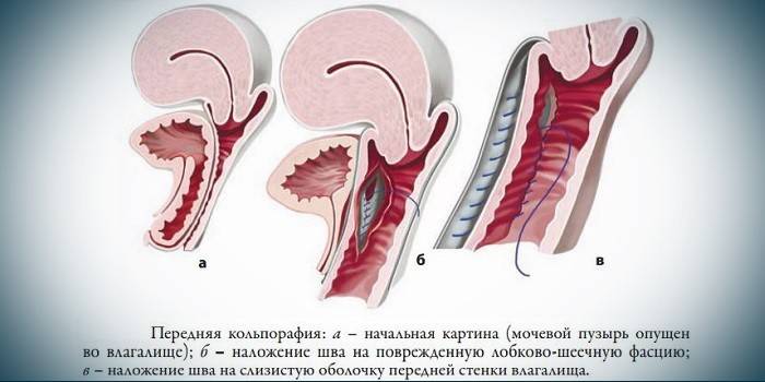 Colporapia vaginal