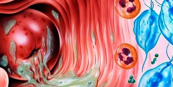 Vaginite bactérienne