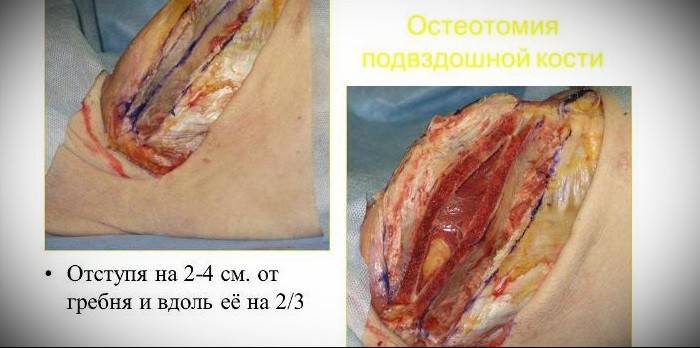 Iliac osteotomija