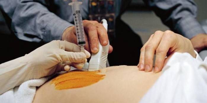 A terhes nőn amniocentesis alakul ki