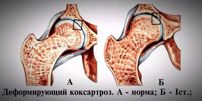 Sağlıklı kalça ve deforme koxartrozdan etkilenir