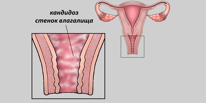 Candidosi vaginale sullo schema
