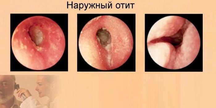 Ārējās auss vidusauss iekaisuma izpausmes