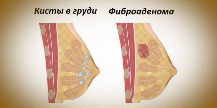 Киста и фиброаденом в гърдата