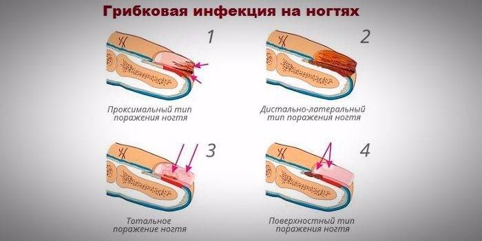 Types de champignons des ongles