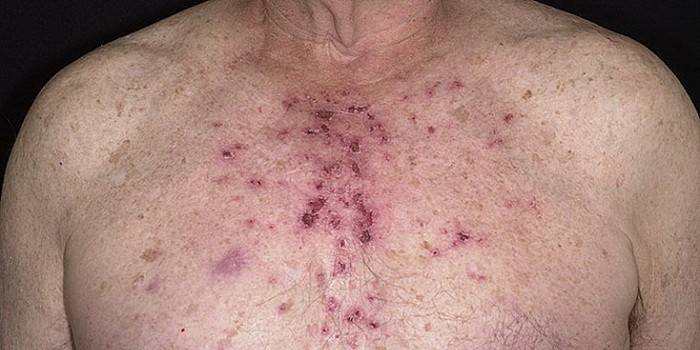 hyperkeratosis Follicular ของหนังกำพร้า