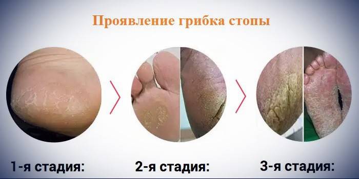 Etapele dezvoltării ciupercii piciorului