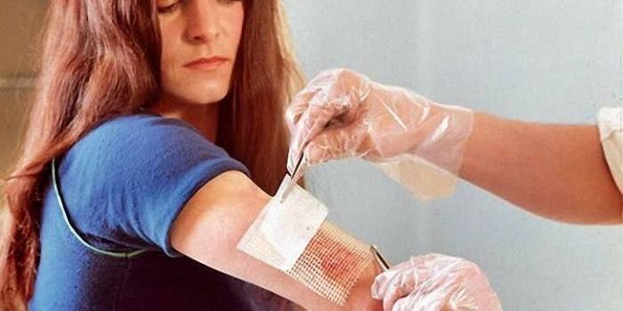 A menina é tratada com uma queimadura na mão