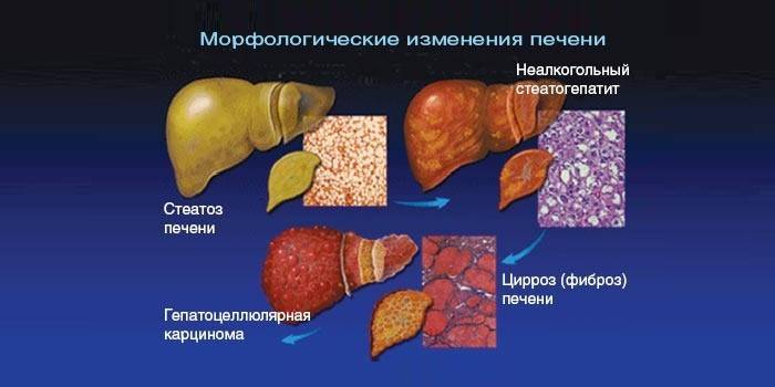 Чернодробно заболяване