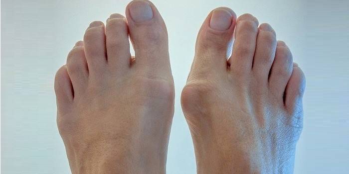 Entzündung des Gelenkbeutels des großen Zehs