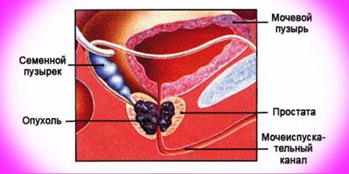 Khối u tuyến tiền liệt