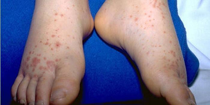 La gale sur les pieds d'un bébé