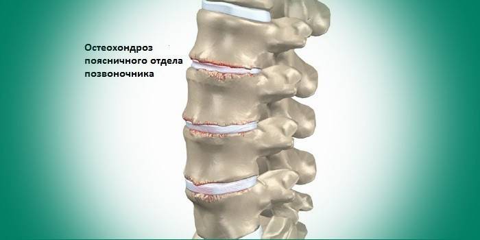 Osteocondrosi lumbar
