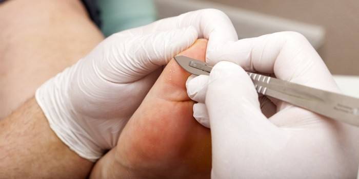 Medicul ia o răzuială de pe pielea piciorului