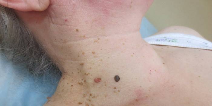 Keratosis Seborrheic ที่คอ