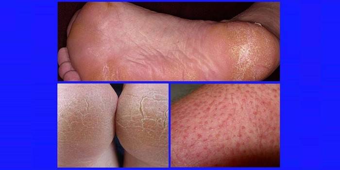 อาการของ hyperkeratosis ของเท้า