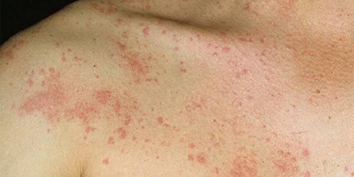 Urticaria en piel humana