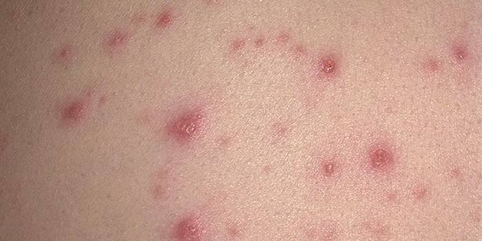 Impetigo tepalo Baneocin gydymas