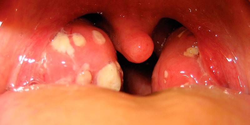 Infezione da tonsille streptococciche