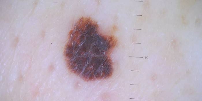 Photo de naevus dysplasique sur la peau humaine