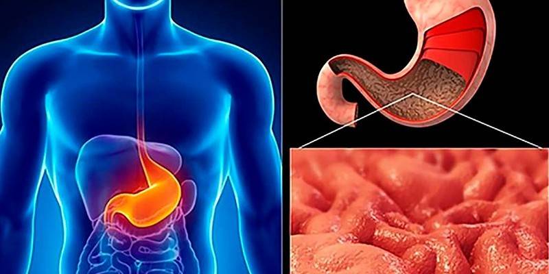 Changement dystrophique dans la muqueuse gastrique