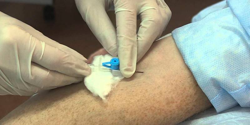 Infusion catheter insertion