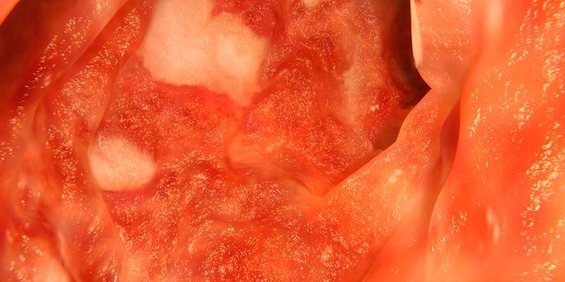 Colitis ulcerosa