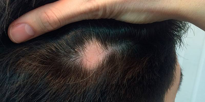 Perte de cheveux focale